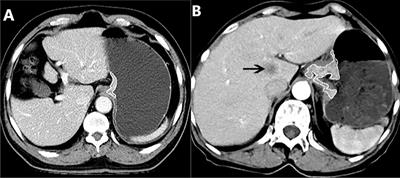 Gross tumor volume of adenocarcinoma of esophagogastric junction corresponding to cT and cN stages measured with computed tomography to quantitatively determine resectabiliy: A case control study